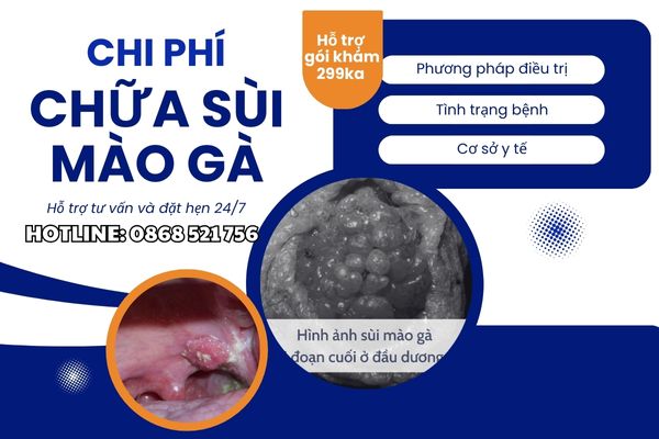 Chi phí chữa sùi mào gà