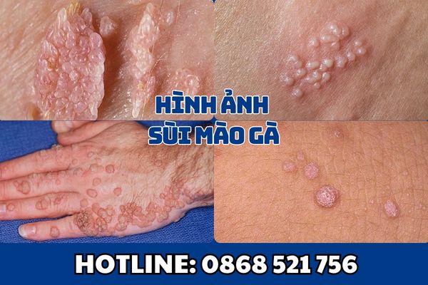 Hình ảnh sùi mào gà