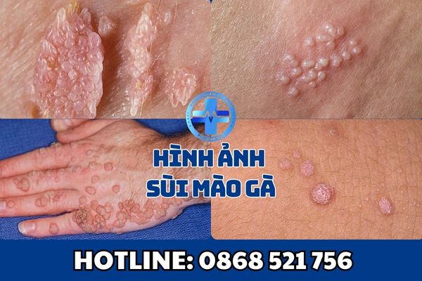 Hình ảnh sùi mào gà