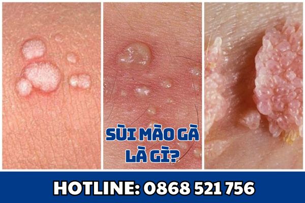 Sùi mào gà là gì?