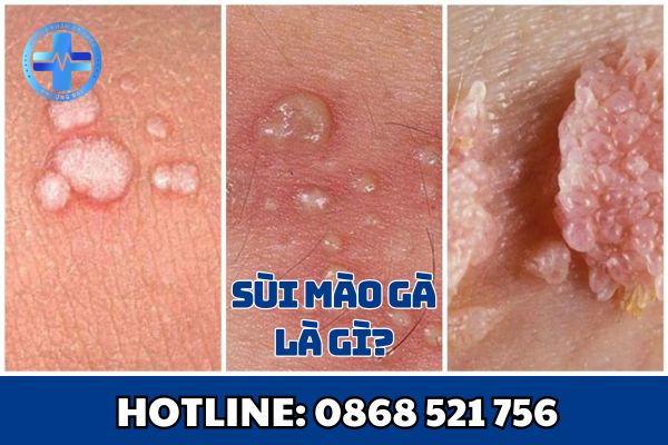 Sùi mào gà là gì?