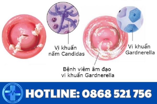 Viêm âm đạo là gì?