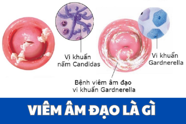 Viêm âm đạo là gì?