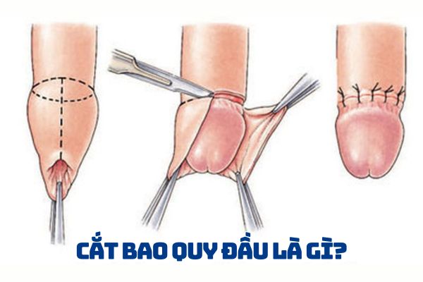 Cắt bao quy đầu là gì?