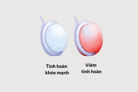 Chi phí điều trị viêm tinh hoàn ở Quy nhơn bao nhiêu?