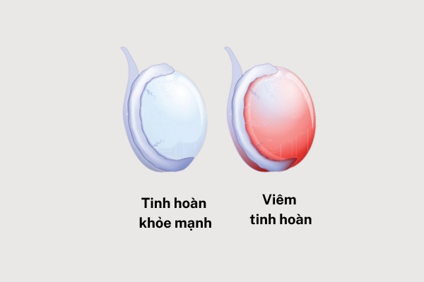 Chi phí điều trị viêm tinh hoàn ở Quy nhơn bao nhiêu?