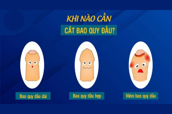 Khi nào cần cắt bao quy đầu