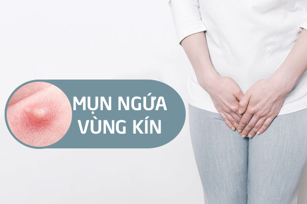 Nổi mụn ở mép vùng kín: Nguyên nhân và cách trị hiệu quả