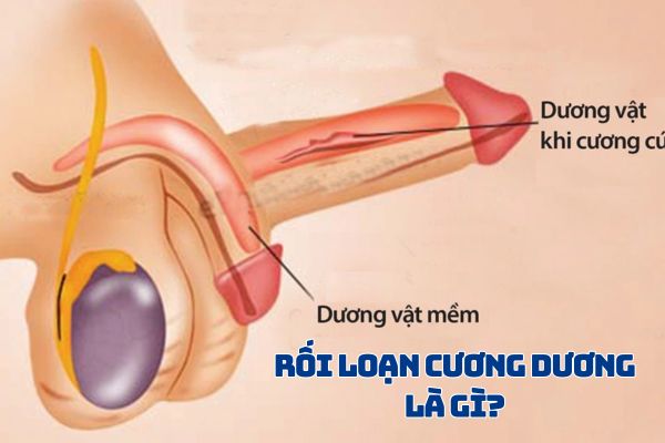 Rối loạn cương dương là gì?