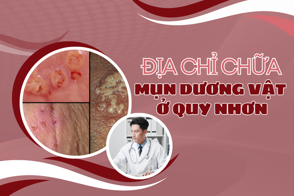 Địa chỉ chữa mụn dương vật ở Huyện Tuy Phước hiệu quả – uy tín