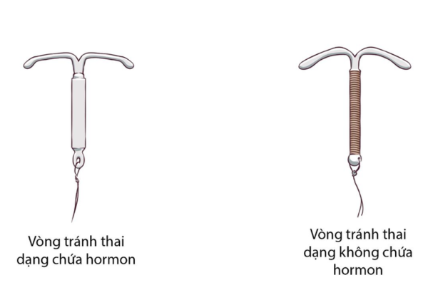 Có bao nhiêu loại vòng tránh thai?