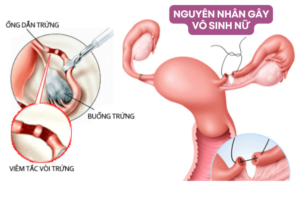 Nguyên nhân gây vô sinh nữ