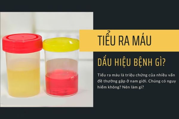 Tiểu ra máu là dấu hiệu của bệnh gì?